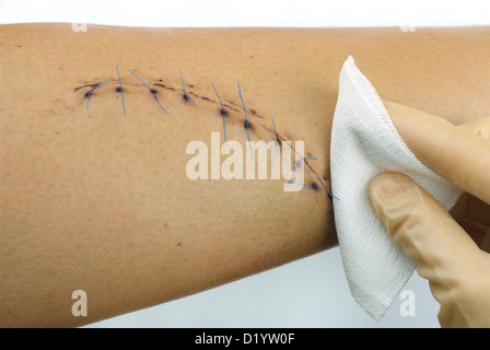 Libre d'une couture nettoyage enroulé sur une jambe mâle. 10 points de suture, 15 cm de long. Banque D'Images