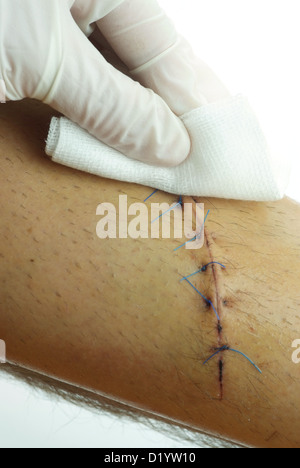 Libre d'une couture nettoyage enroulé sur une jambe mâle. 10 points de suture, 15 cm de long. Banque D'Images