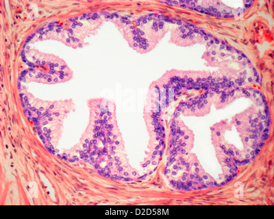 La maladie de Basedow Lumière Microphotographie d'une section à travers la glande thyroïde à partir d'un follicule Banque D'Images