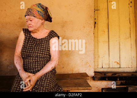 Portrait de femme albinos âgées. Banque D'Images