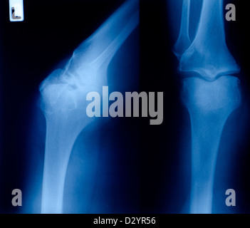 Xray montrant l'arthrose du genou droit Banque D'Images