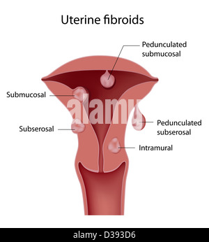 Des fibromes utérins Banque D'Images