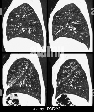 CT scan montrant la fibrose kystique des poumons Banque D'Images