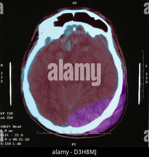L'hématome, BRAIN SCAN Banque D'Images