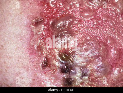 L’HERPÈS ZOSTER Banque D'Images