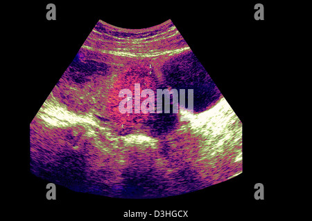 Fibrome utérin, l'échographie Banque D'Images