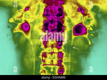 La lithiase urétérale, X-RAY Banque D'Images