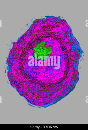 L'athérome, l'histologie Banque D'Images