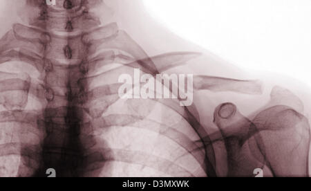 X-ray de l'épaule fracture de la clavicule montrant un Banque D'Images