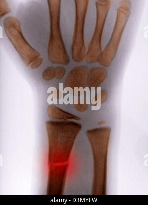 X-ray montrant une fracture du radius distal chez un enfant Banque D'Images