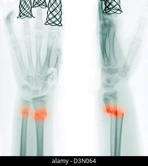 X-ray montrant une fracture de la partie distale du radius et cubitus dans une jeune fille de 12 ans Banque D'Images