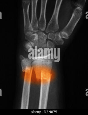 X-ray montrant une fracture de la partie distale du radius et cubitus dans une jeune fille de 12 ans Banque D'Images