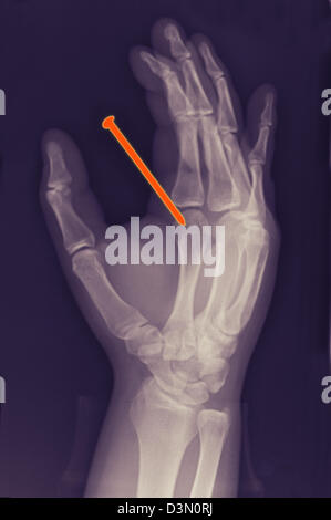 Hand x-ray of a 26 year old man qui accidentellement tiré sur un clou d'une cloueuse à travers sa main Banque D'Images