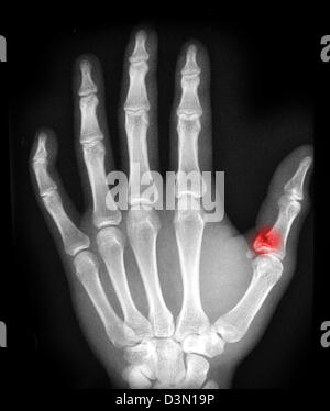 X-ray montrant une fracture-avulsion de la phalange proximale du pouce Banque D'Images