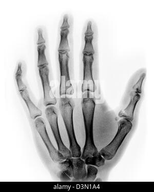 X-ray montrant une fracture-avulsion de la phalange proximale du pouce Banque D'Images
