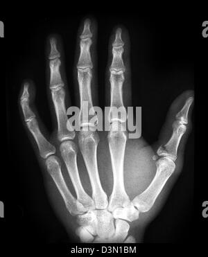 X-ray montrant une fracture-avulsion de la phalange proximale du pouce Banque D'Images