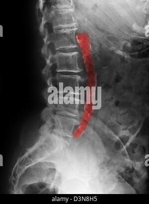 X-ray d'une femme de 81 ans montrant une aorte calcifiée de la maladie artérielle athéromateuse Banque D'Images