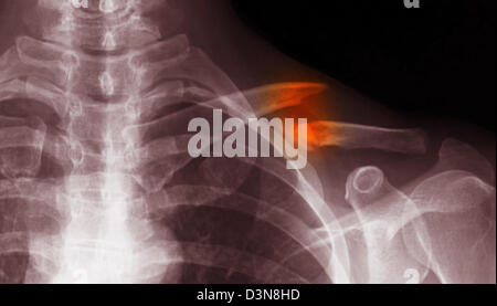 X-ray de l'épaule fracture de la clavicule montrant un Banque D'Images