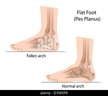 Pied plat Banque D'Images
