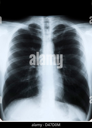 X-ray de poitrine, Close up Banque D'Images