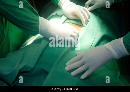 La région abdominale est nettoyé avec un antiseptique à base d'iode pour minimiser les risques de l'infection post-opératoire. Banque D'Images