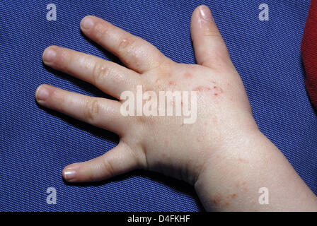 (Afp) le fichier photo datée du 14 février 2007 montre des mains d'un enfant en portant les symptômes de la main-pied-bouche-et-(MMPB) à Francfort-sur-Main, Allemagne. Photo : Thorsten Lang Banque D'Images