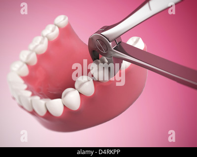 Extraction de dent Banque D'Images