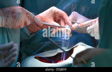Chirurgien cardiaque met une nouvelle pompe sanguine mécanique dans la poitrine du patient à l'Institut de médecine clinique et expérimentale (IKEM) à Prague, République tchèque, le 3 avril 2013. IKEM fête ses dix ans à l'aide de cette méthode. (Photo/CTK Michal Dolezal) Banque D'Images