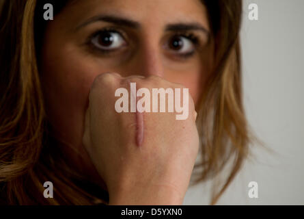 Rola El-Halabi Boxer montre une cicatrice sur le dos de sa main après une conférence de presse à Ulm, Allemagne, 5 novembre 2012. El-Halabi, qui a été tué par son beau-père, célèbre son retour en force avec un boxe lutte contre Lucia Morelli, le 12 janvier 2013. Photo : MARIJAN MURAT Banque D'Images