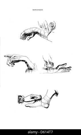 L'édition 1878 de 'A Domestic Cyclopædia of Practical information' fournit des informations utiles sur diverses pratiques à domicile, y compris l'application de bandages pour les premiers soins. L'entrée détaille les méthodes de traitement des blessures, offrant des conseils pratiques pour les soins de santé à domicile. Banque D'Images