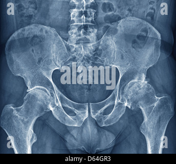 L'arthrose de la hanche, X-ray Banque D'Images