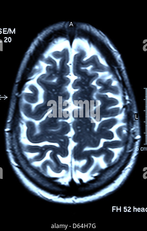 Brain Scan, IRM Banque D'Images