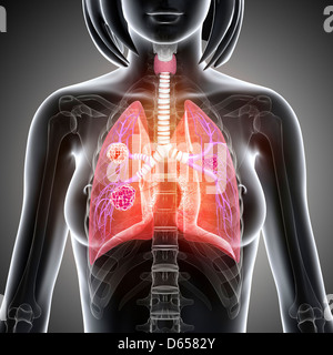 Le cancer du poumon féminin, artwork Banque D'Images