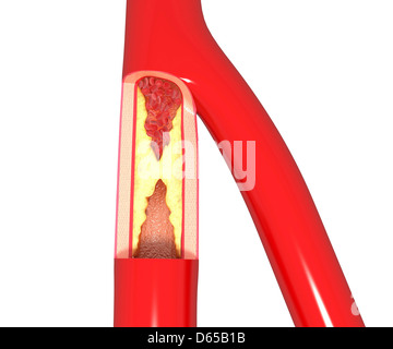 L'athérosclérose, artwork Banque D'Images