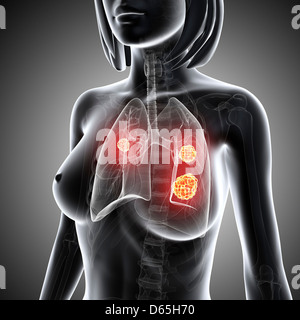 Le cancer du poumon féminin, artwork Banque D'Images