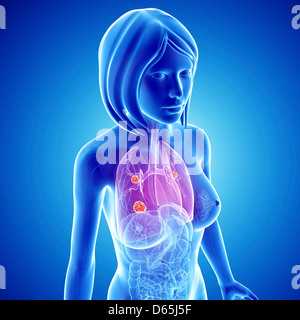 Le cancer du poumon féminin, artwork Banque D'Images