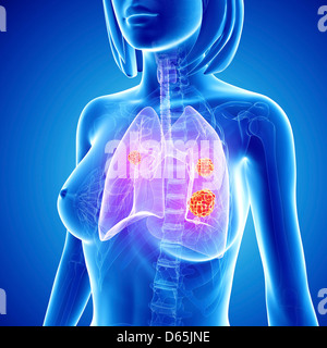 Le cancer du poumon féminin, artwork Banque D'Images