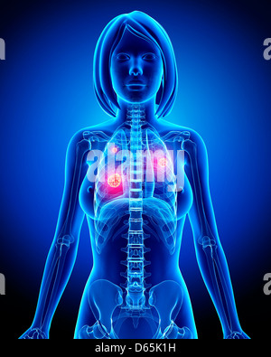 Le cancer du poumon féminin, artwork Banque D'Images