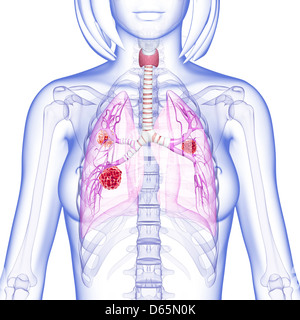 Le cancer du poumon féminin, artwork Banque D'Images