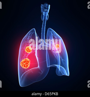 Le cancer du poumon, artwork Banque D'Images