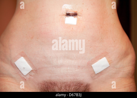 L'estomac d'une femme montrant le fonctionnement des cicatrices d'une laparoscopie ( micromanipulation chirurgicale ) 1 jour, UK Banque D'Images