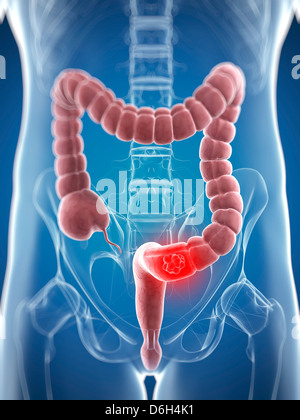 Le cancer du côlon, artwork Banque D'Images