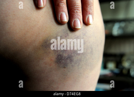 Montre Femme avec des blessures à la peau d'ecchymoses sur la cuisse de la jambe après une chute Banque D'Images
