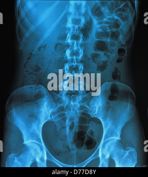 X-ray du bassin et de la colonne vertébrale Banque D'Images