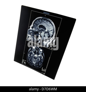 X-ray image de la tomodensitométrie cérébrale Banque D'Images