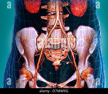 Aorte abdominale, 3D CT scan Banque D'Images
