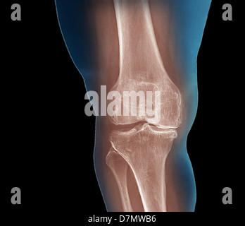 L'arthrite du genou, X-ray Banque D'Images