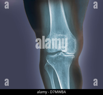 L'arthrite du genou, X-ray Banque D'Images