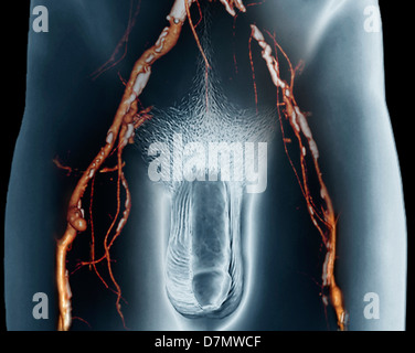 Rétrécissement des artères, 3D CT scan Banque D'Images