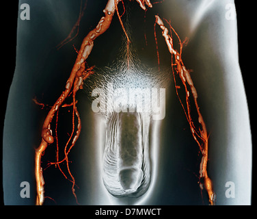 Rétrécissement des artères, 3D CT scan Banque D'Images